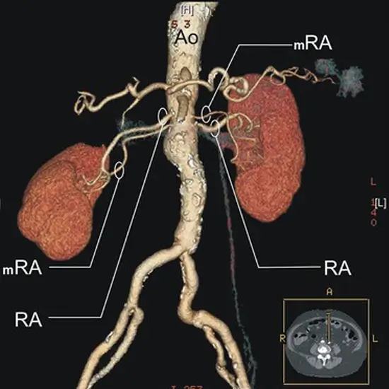 MR Angiography Right Kidney